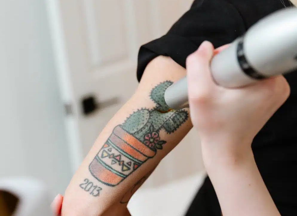how long does tattoo removal take to heal?